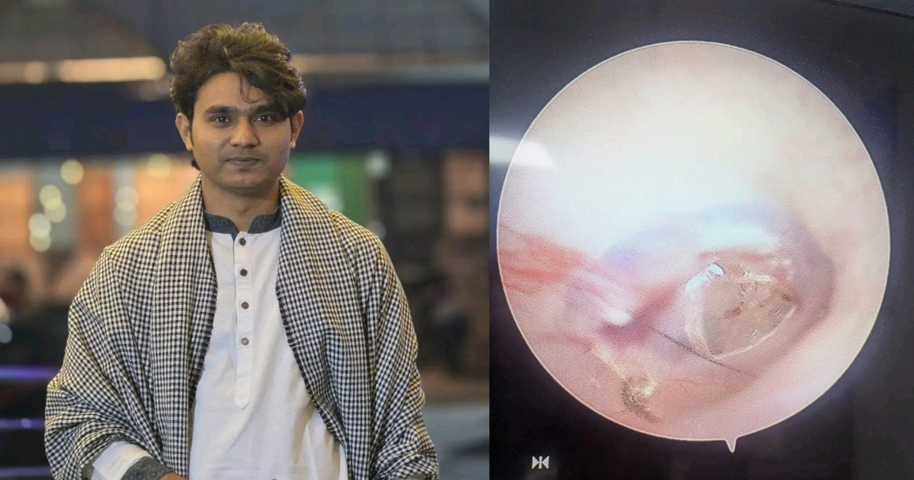 শাহবাগ থানায় হামলার ঘটনায় ঢাবি শিক্ষার্থী জুলহাসের কানের পর্দা ক্ষতিগ্রস্ত